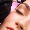 Skin Needling – Effective Treatment for Flawless Skin