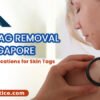 Skin tag removal in Singapore