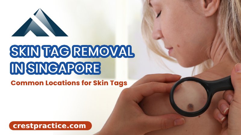 Skin tag removal in Singapore