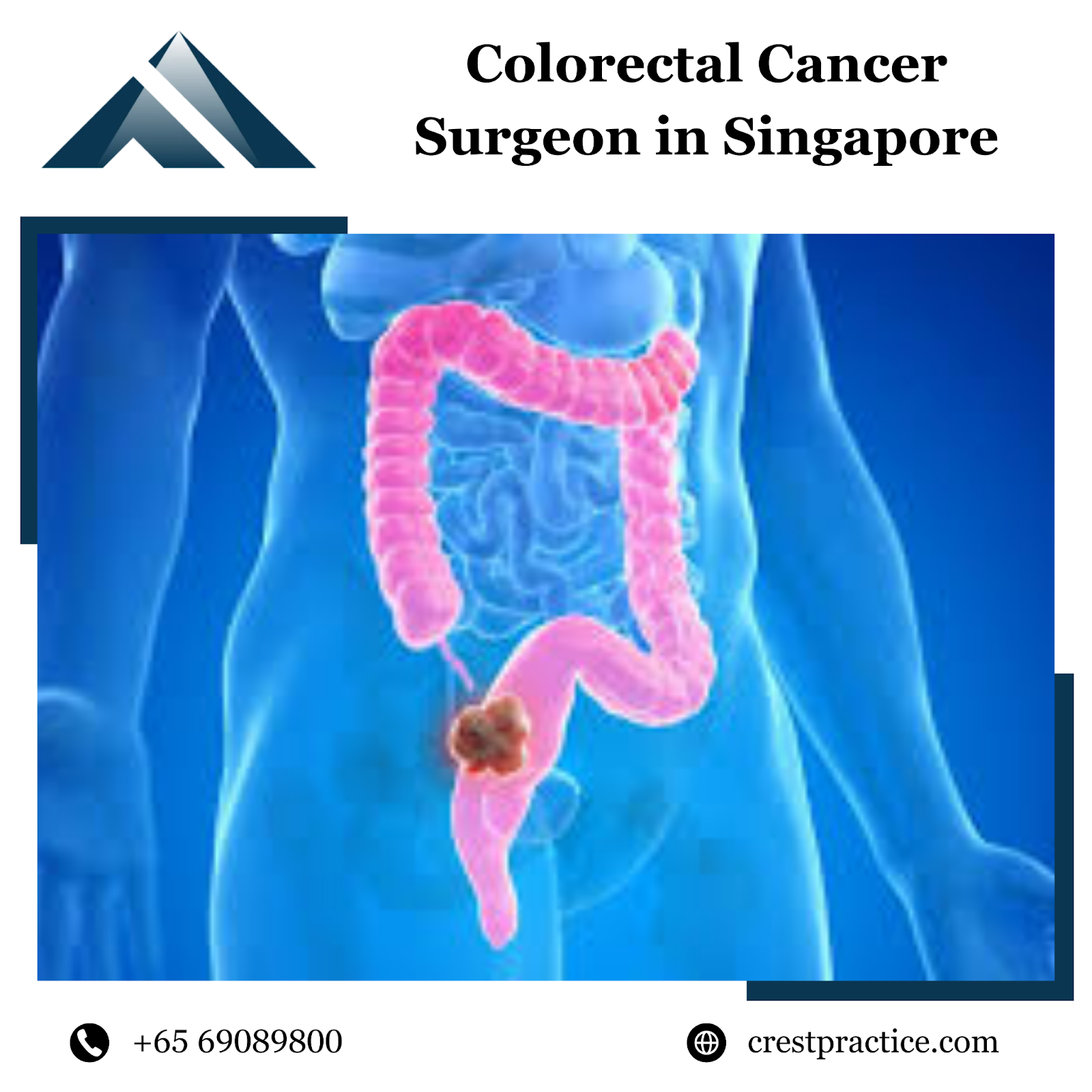 Colorectal cancer surgery in Singapore