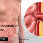 Understanding Hernia Surgery: Procedures, Types, and Recovery in Singapore