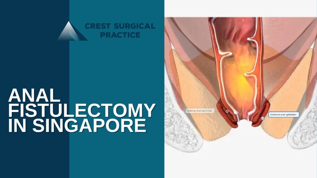 Comprehensive Insights into Treating Anal Fistulas Surgically